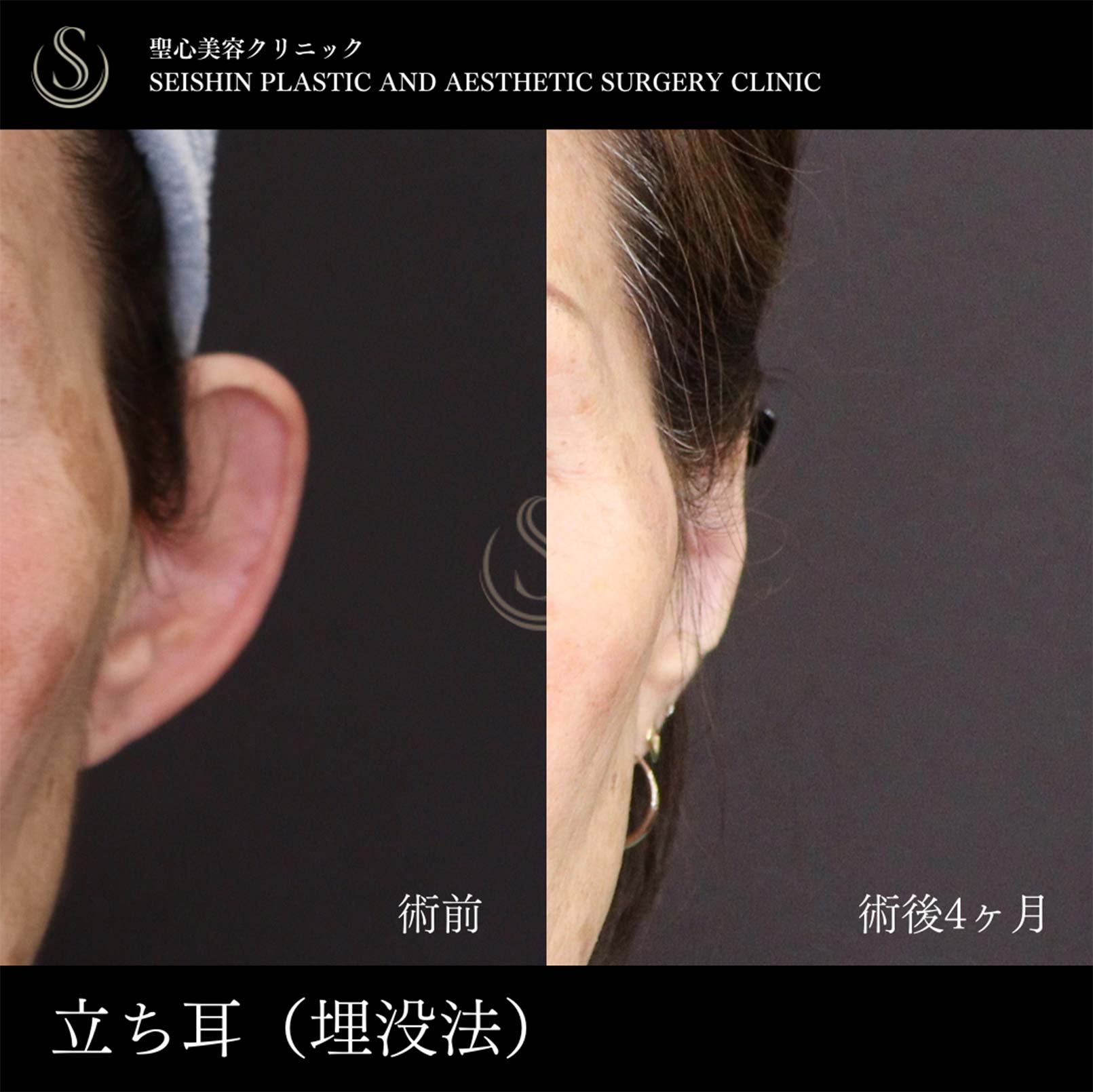【70代女性・立ち耳を糸で改善】立ち耳修正（埋没法）（術後4ヶ月） After 