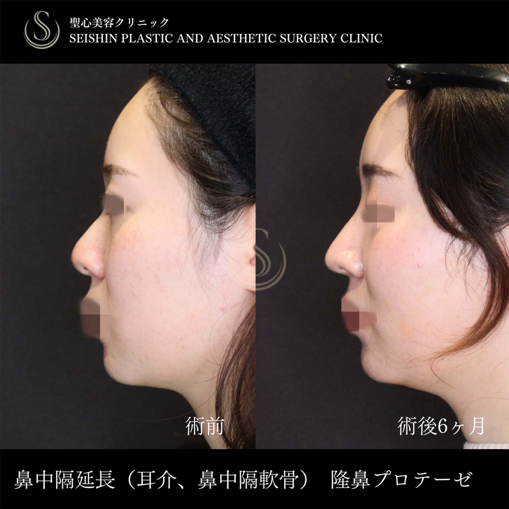 【20代女性・鼻中隔延長で忘れ鼻に】 鼻中隔延長術＋鼻尖縮小＋プロテーゼによる隆鼻術（術後6ヶ月） Before 