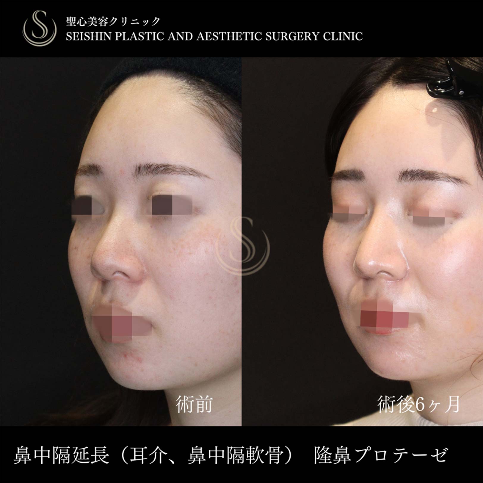 【20代女性・鼻中隔延長で忘れ鼻に】 鼻中隔延長術＋鼻尖縮小＋プロテーゼによる隆鼻術（術後6ヶ月） After 