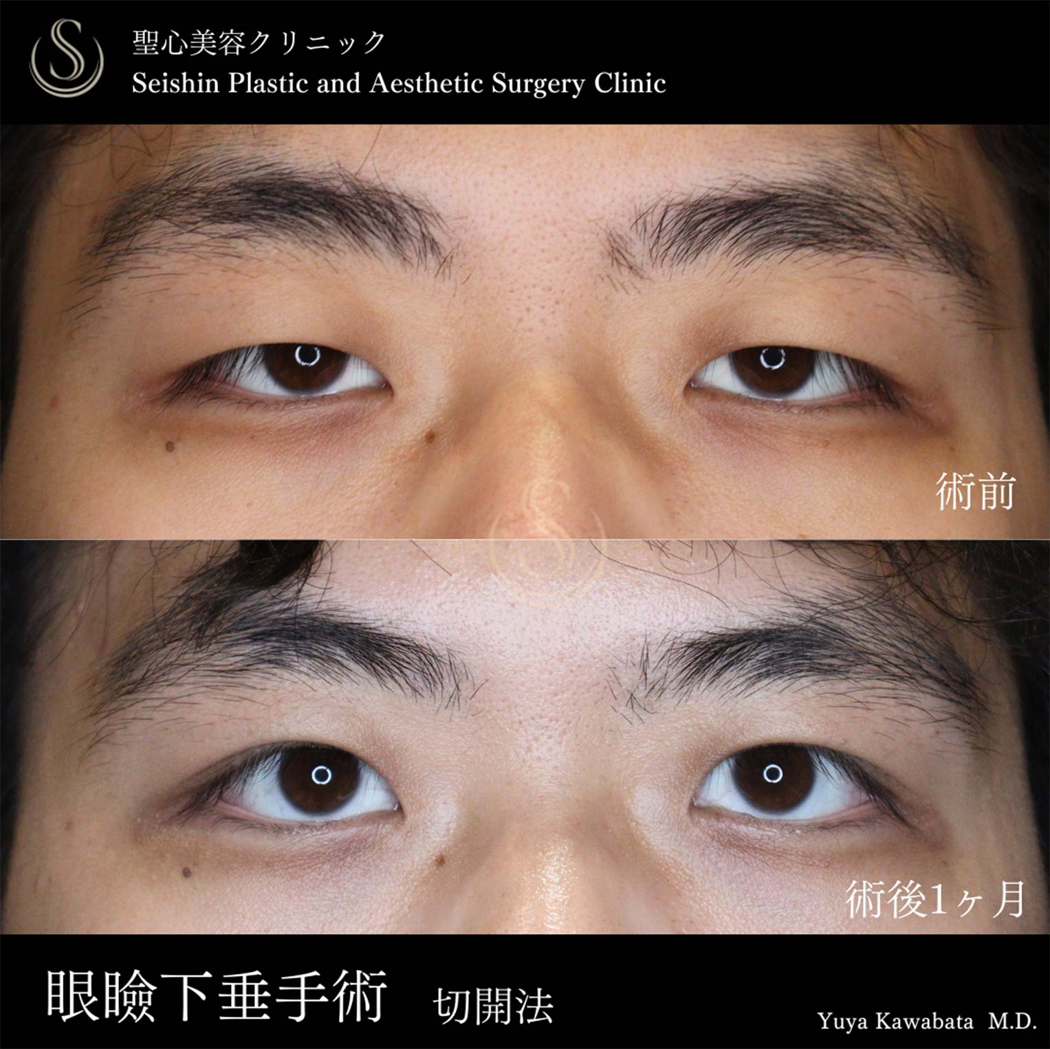 【20代男性・眼瞼下垂手術で目力を】眼瞼下垂（切開法/腱膜縫縮法）（術後1ヶ月） Before 