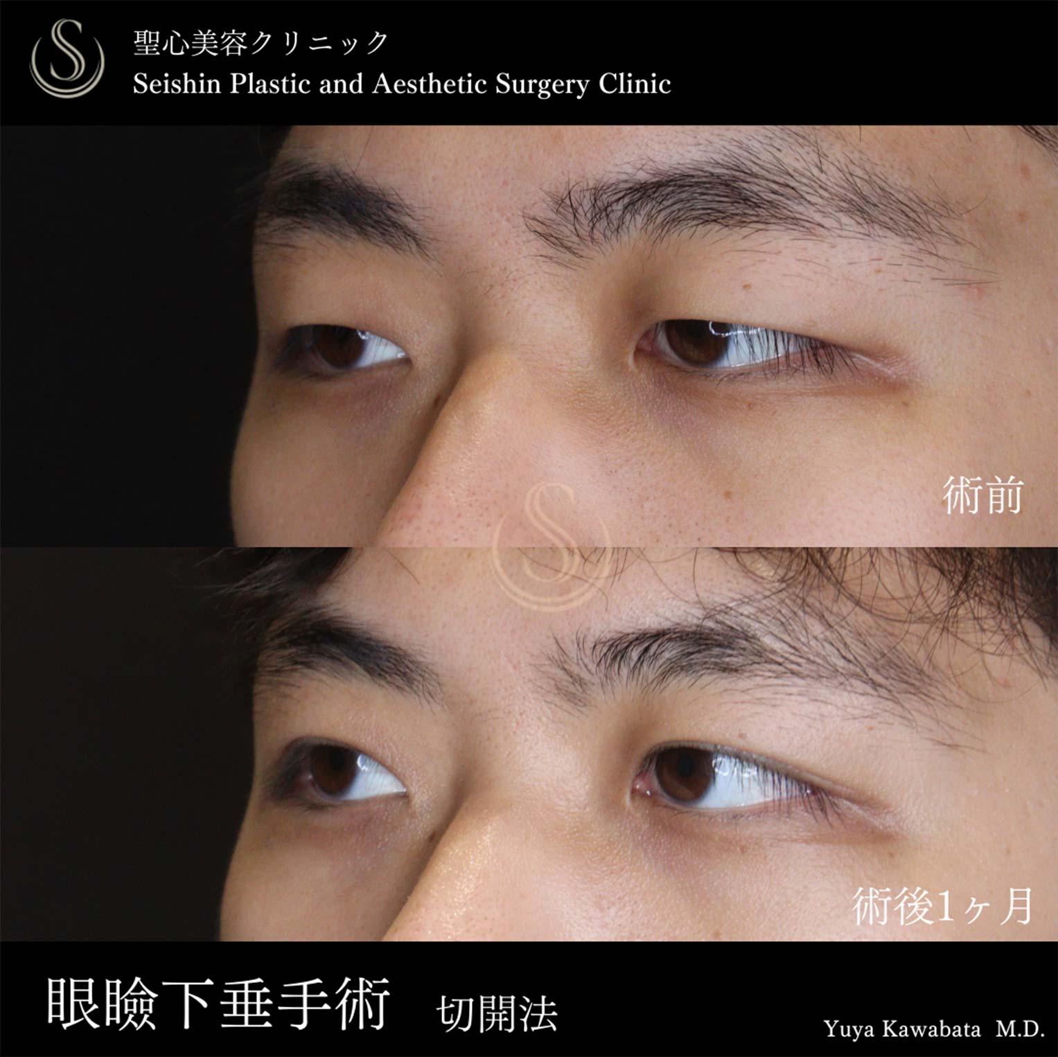 【20代男性・眼瞼下垂手術で目力を】眼瞼下垂（切開法/腱膜縫縮法）（術後1ヶ月） After 