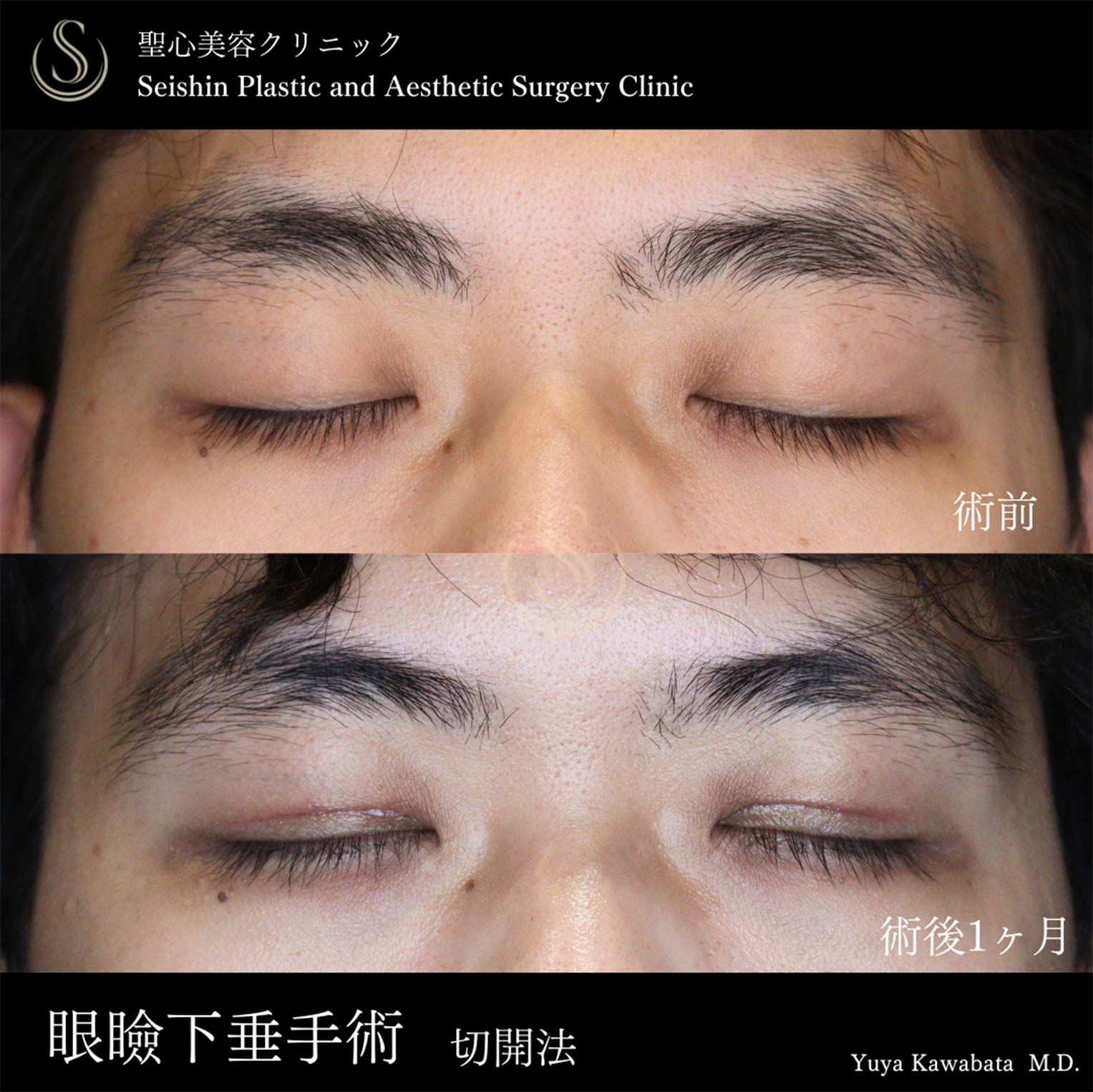 【20代男性・眼瞼下垂手術で目力を】眼瞼下垂（切開法/腱膜縫縮法）（術後1ヶ月） After 