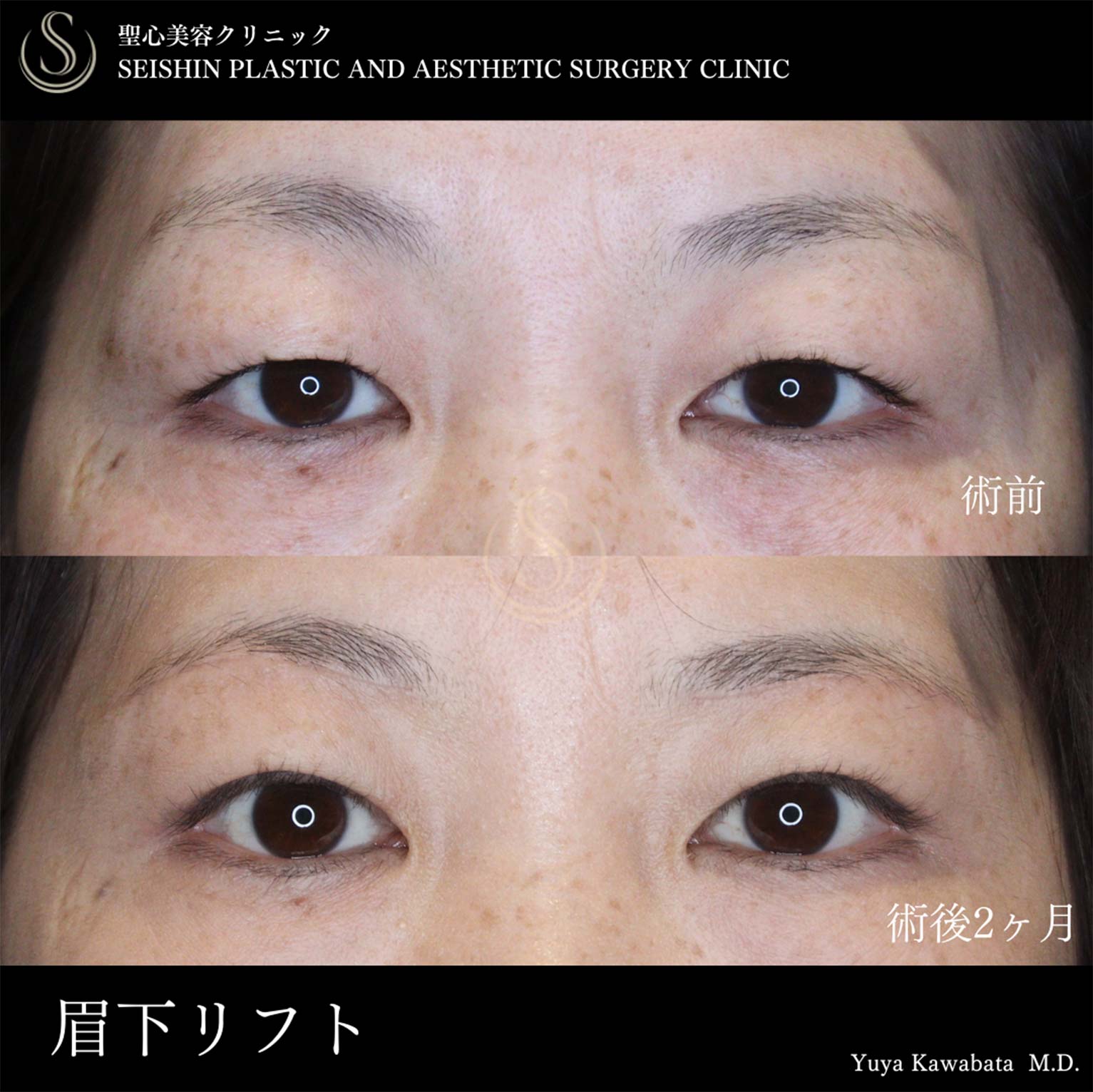 【40代女性・眉下リフトで目元をスッキリ】眉下切開法（眉下リフト）（術後2ヶ月） Before 