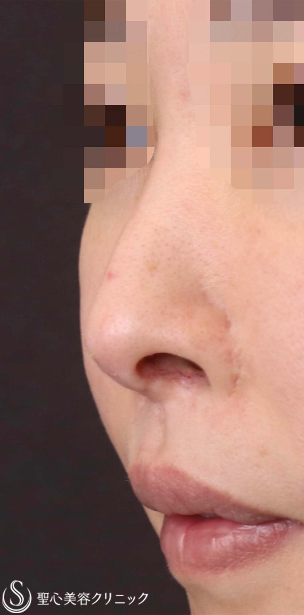 【30代女性・鼻の穴を目立ちにくくしたい！！】鼻孔縁下降術（術後3ヶ月） Before 