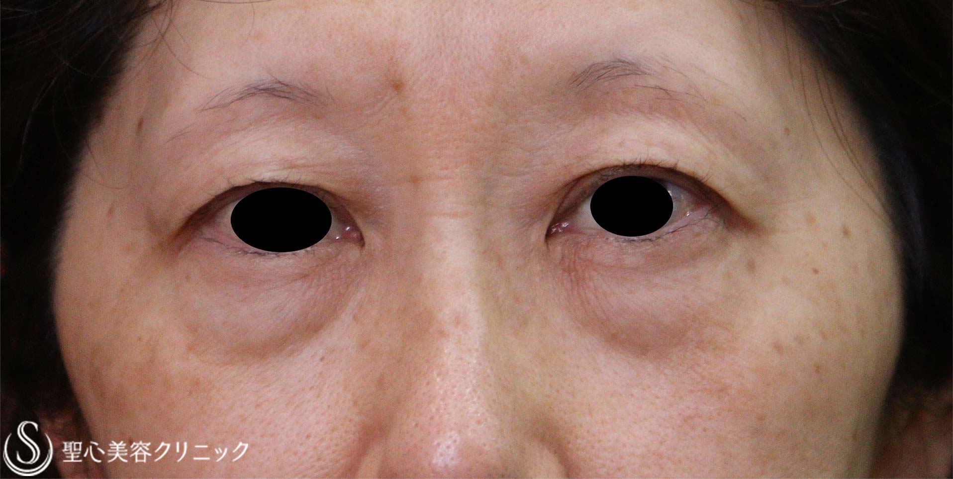 【50代女性・目の下のたるみ】下眼瞼除皺術（脂肪除去あり）（術後1か月） Before 