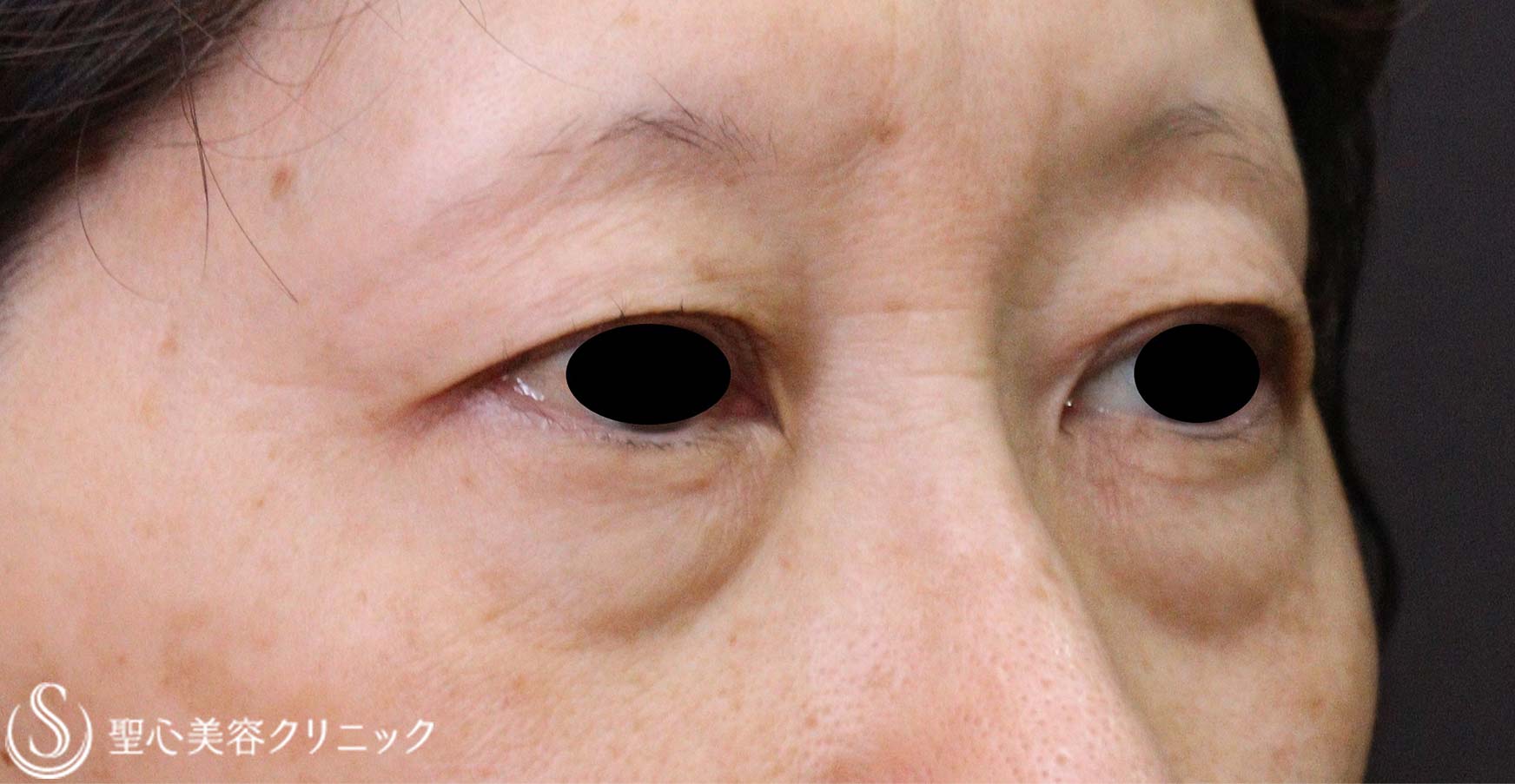 【50代女性・目の下のたるみ】下眼瞼除皺術（脂肪除去あり）（術後1か月） Before 