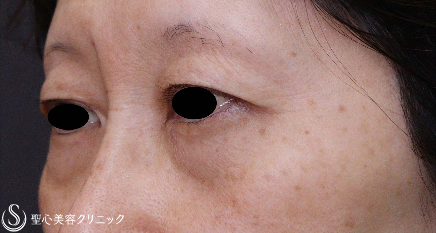 【50代女性・目の下のたるみ】下眼瞼除皺術（脂肪除去あり）（術後1か月） Before 