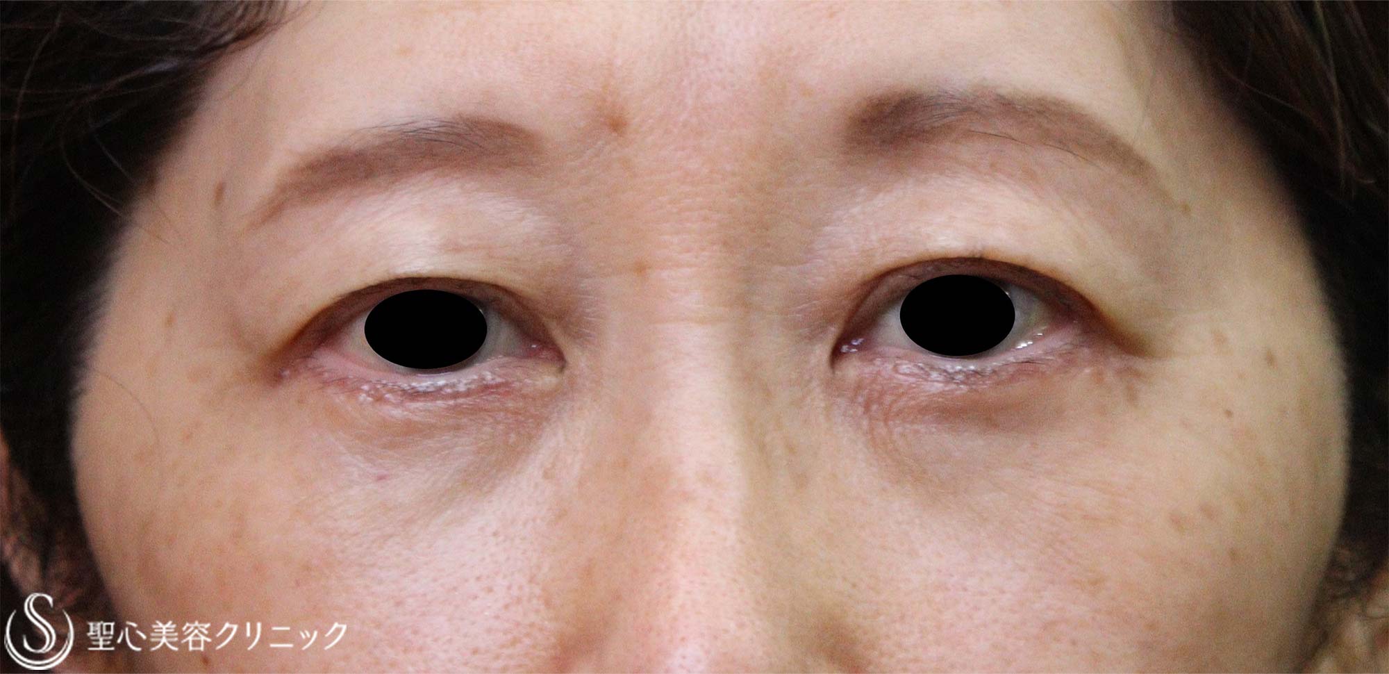 【50代女性・目の下のたるみ】下眼瞼除皺術（脂肪除去あり）（術後1か月） After 