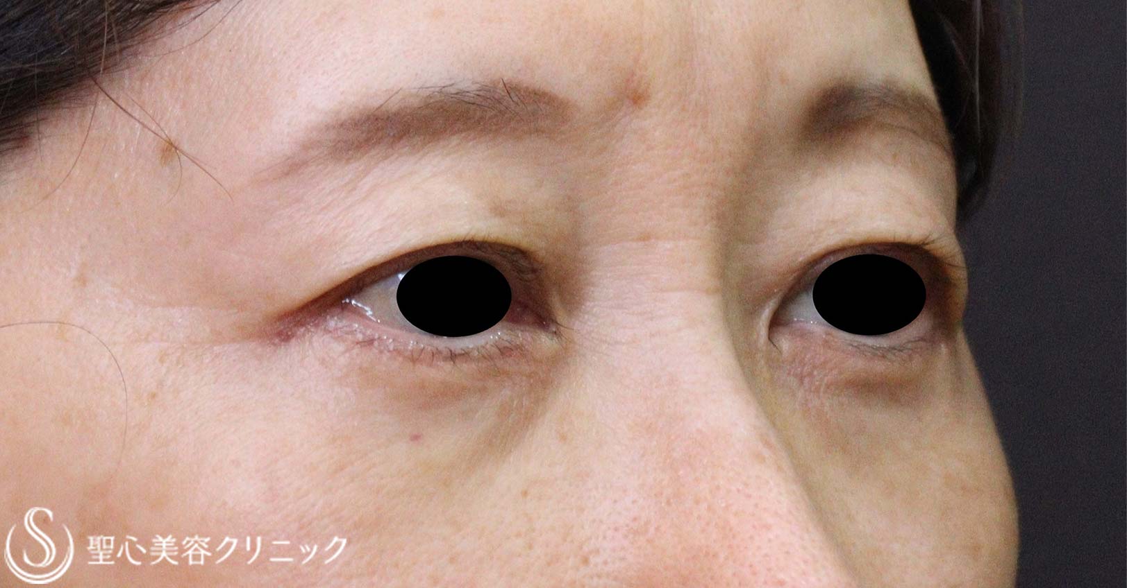 【50代女性・目の下のたるみ】下眼瞼除皺術（脂肪除去あり）（術後1か月） After 