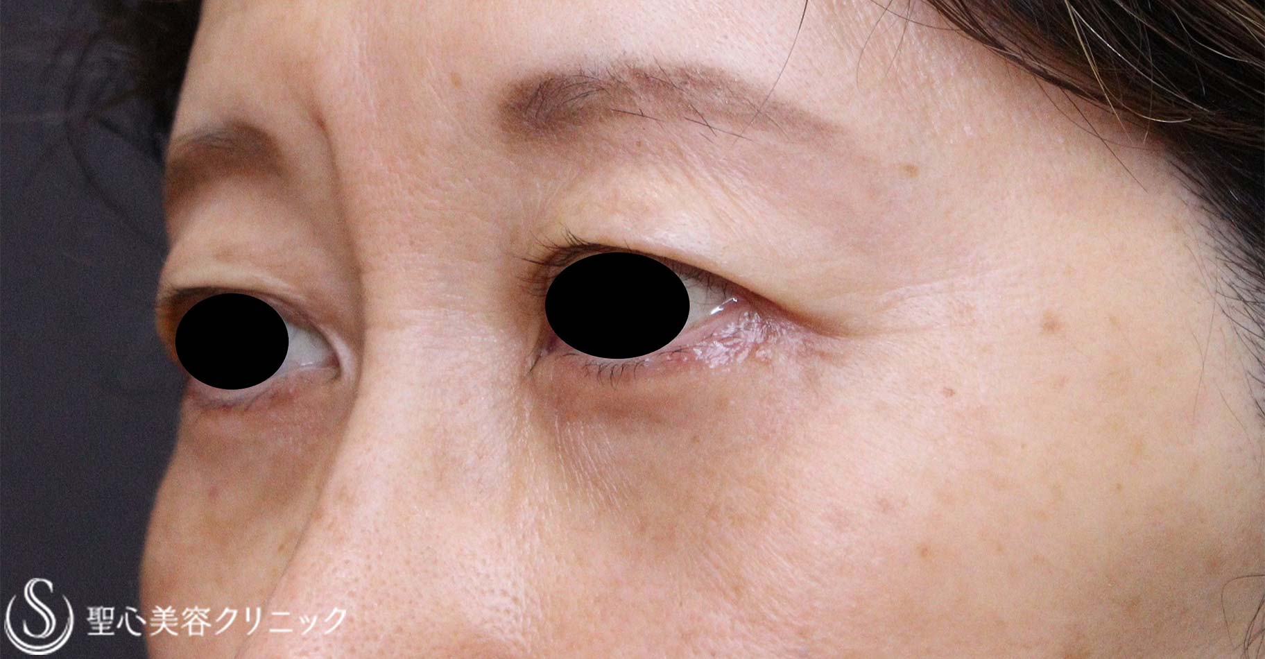 【50代女性・目の下のたるみ】下眼瞼除皺術（脂肪除去あり）（術後1か月） After 