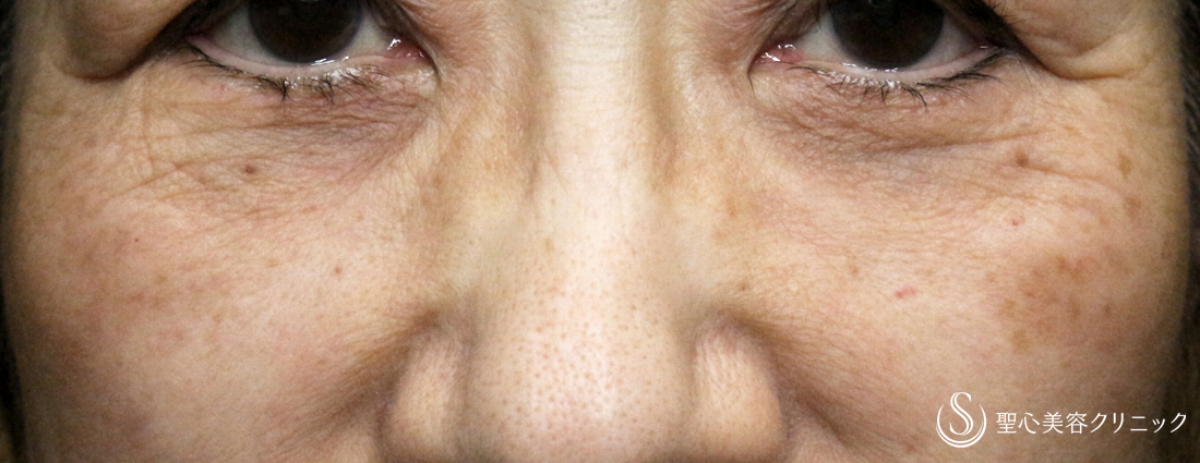 【60代女性・大きな目袋とタルミ】表ハムラ+α法「Ver.2」→外反修正→注入補正（4年後） After 