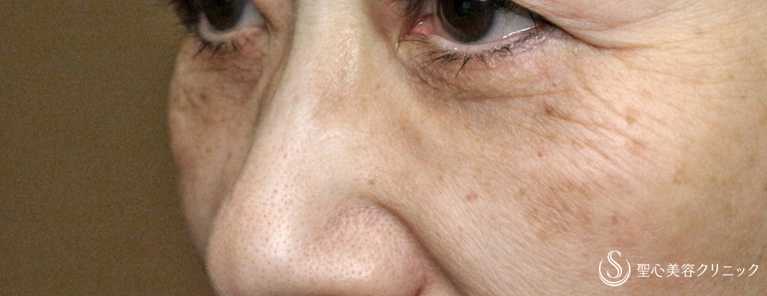 【60代女性・大きな目袋とタルミ】表ハムラ+α法「Ver.2」→外反修正→注入補正（4年後） After 