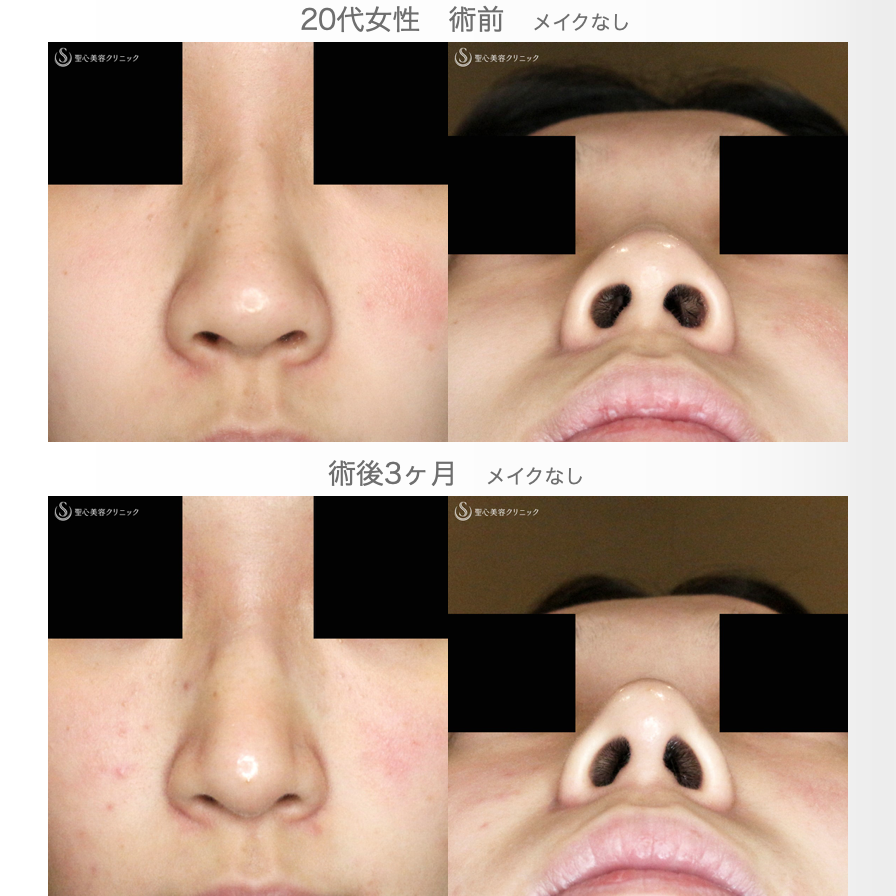 【20代女性・ストラットいらず】鼻尖縮小（耳介軟骨移植）+α法（3ヶ月後） After 