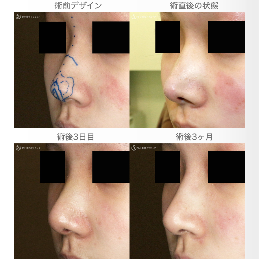 【20代女性・ストラットいらず】鼻尖縮小（耳介軟骨移植）+α法（3ヶ月後） Before 