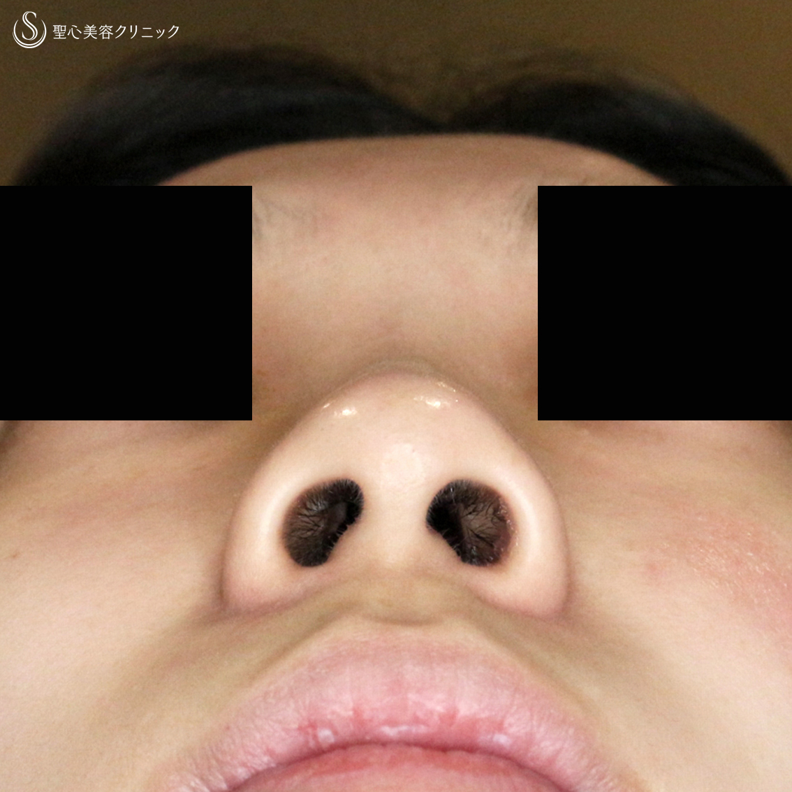 【20代女性・ストラットいらず】鼻尖縮小（耳介軟骨移植）+α法（3ヶ月後） Before 