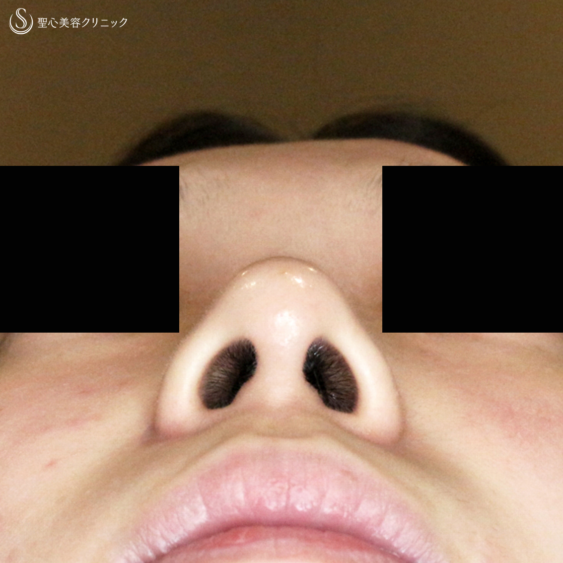 【20代女性・ストラットいらず】鼻尖縮小（耳介軟骨移植）+α法（3ヶ月後） After 