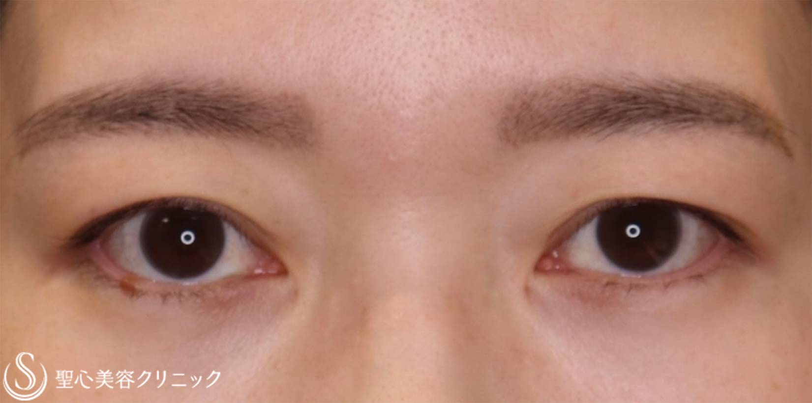 【40代女性・目の上をナチュラルにスッキリ！！】眉下リフト（眉下切開法）（術後2ヶ月） Before 