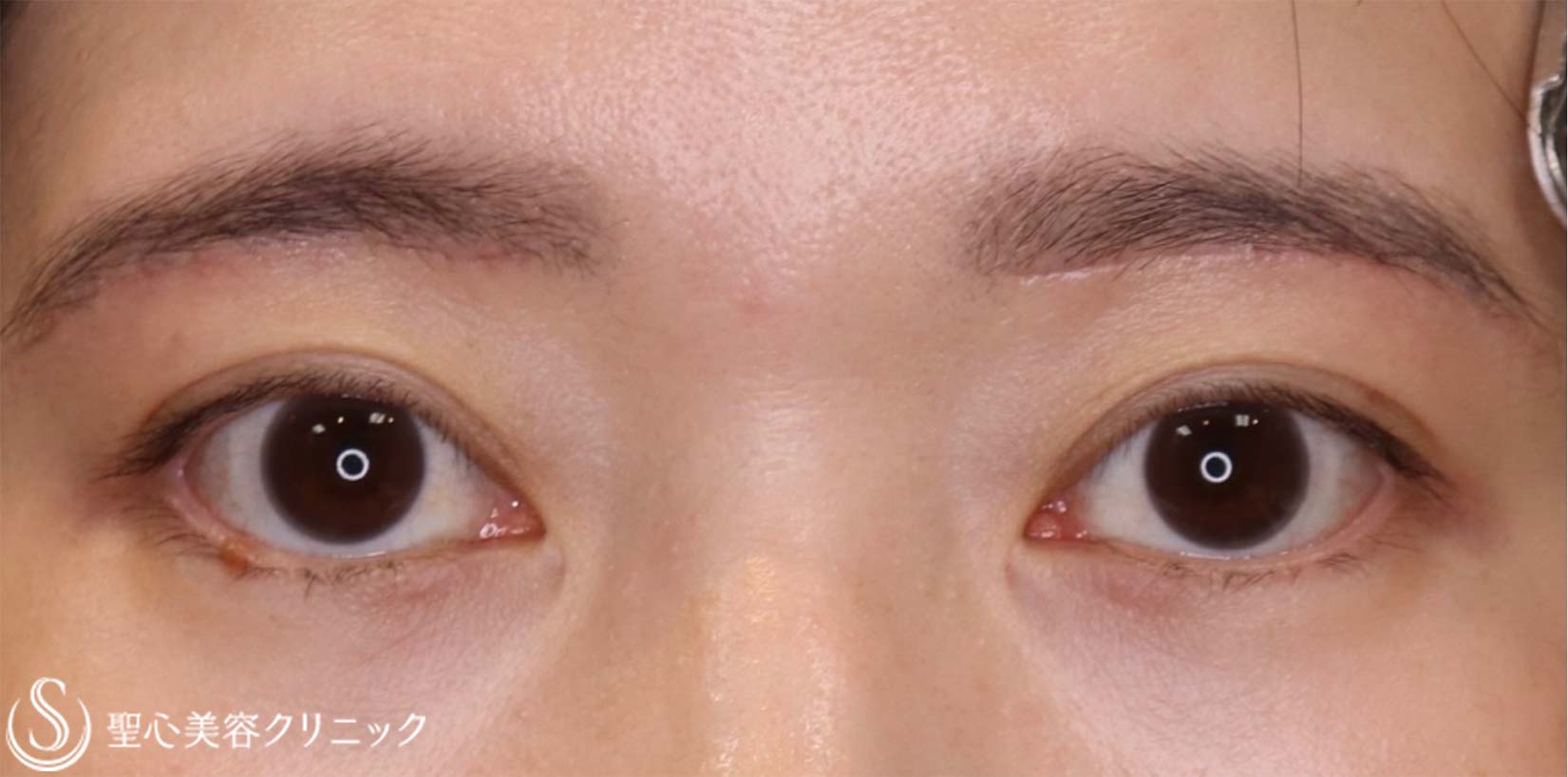 【40代女性・目の上をナチュラルにスッキリ！！】眉下リフト（眉下切開法）（術後2ヶ月） After 