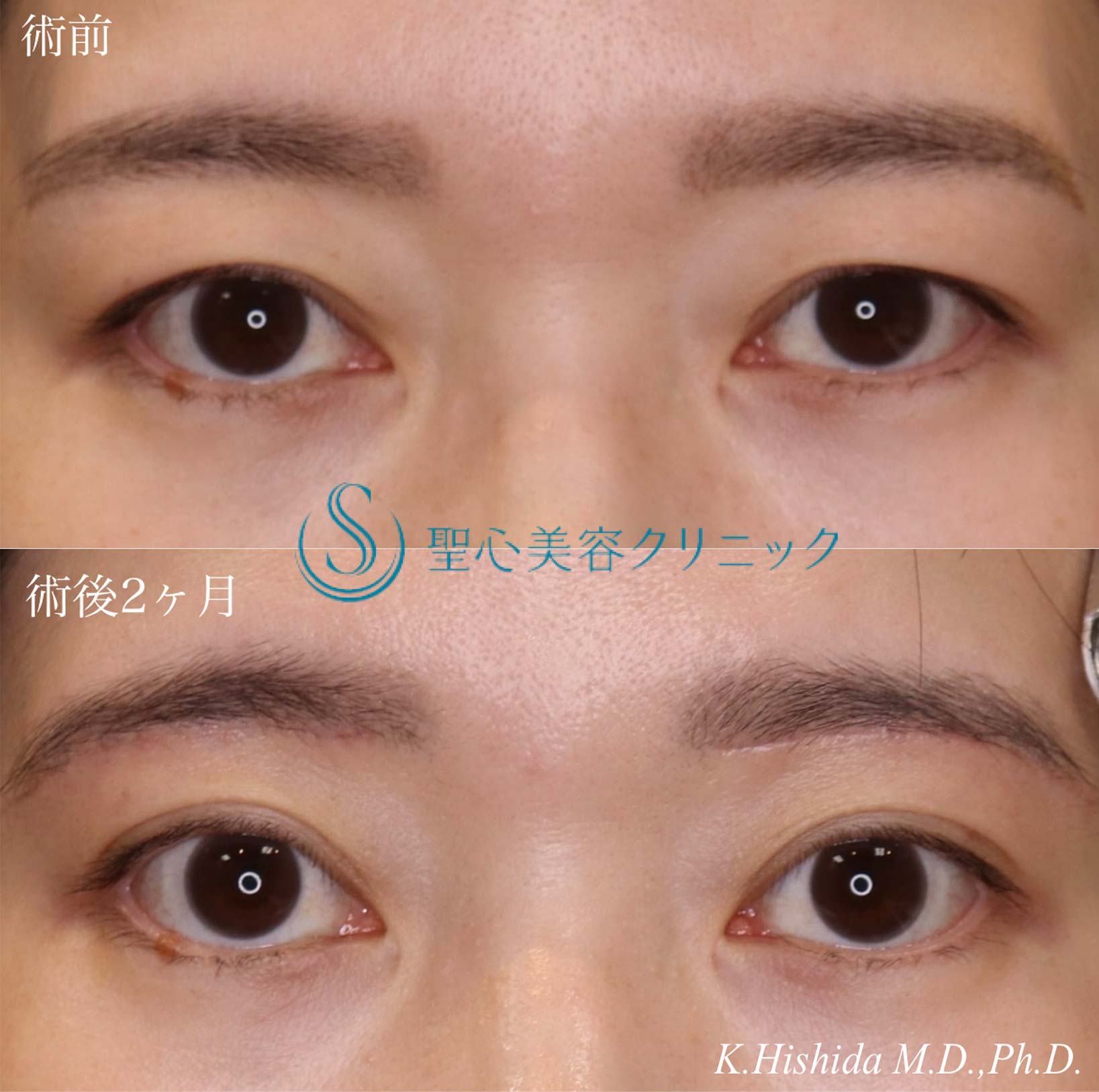 【40代女性・目の上をナチュラルにスッキリ！！】眉下リフト（眉下切開法）（術後2ヶ月） After 