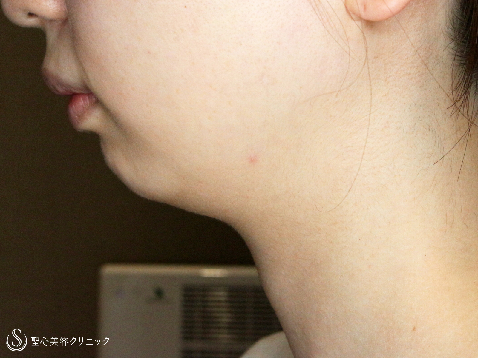 【20代女性・他院修正：二重あご解消】ベイザー脂肪吸引（1年2ヶ月後） Before 