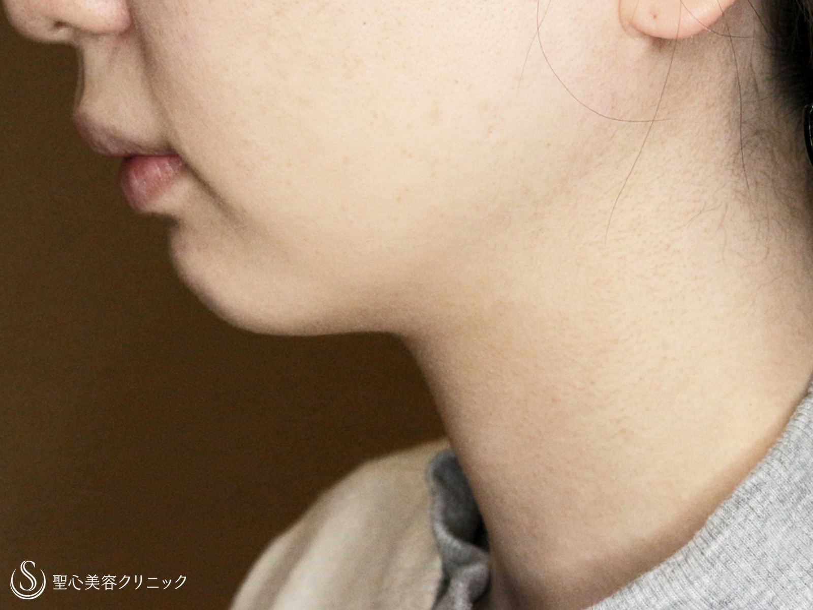 【20代女性・他院修正：二重あご解消】ベイザー脂肪吸引（1年2ヶ月後） After 