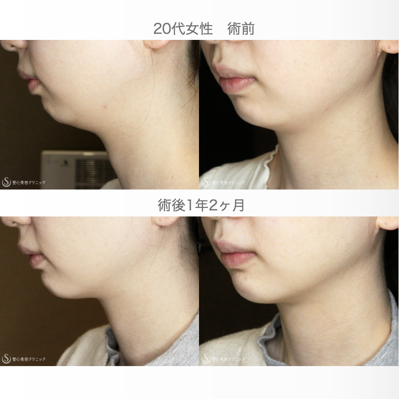 【20代女性・他院修正：二重あご解消】ベイザー脂肪吸引（1年2ヶ月後） After 