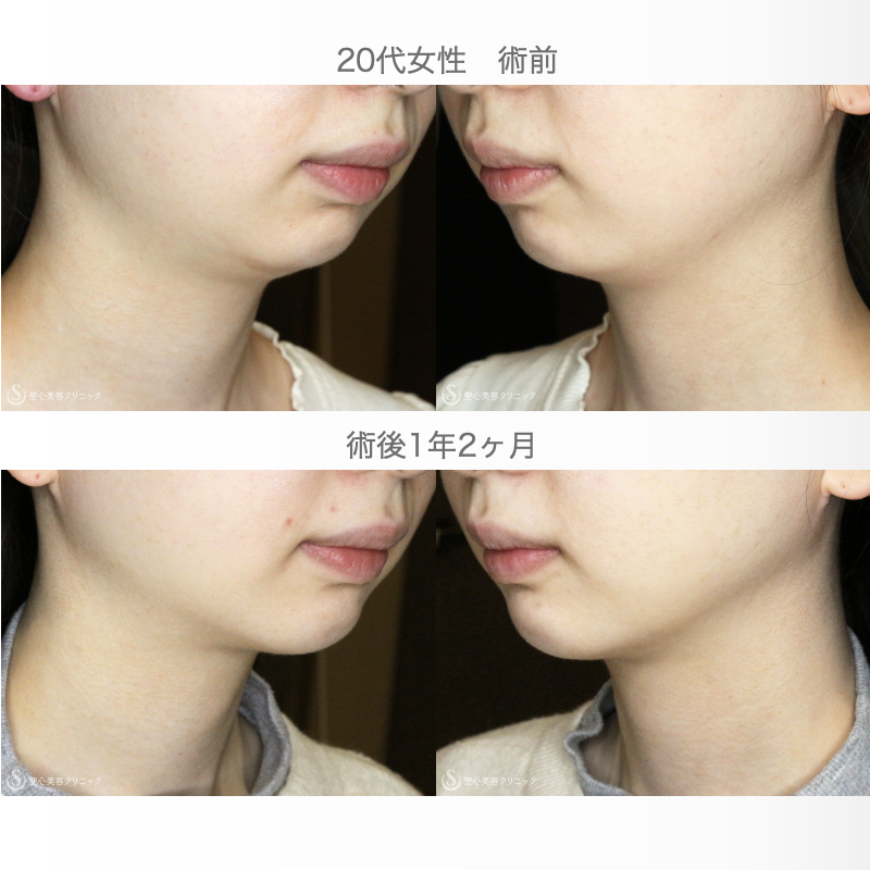 【20代女性・他院修正：二重あご解消】ベイザー脂肪吸引（1年2ヶ月後） After 