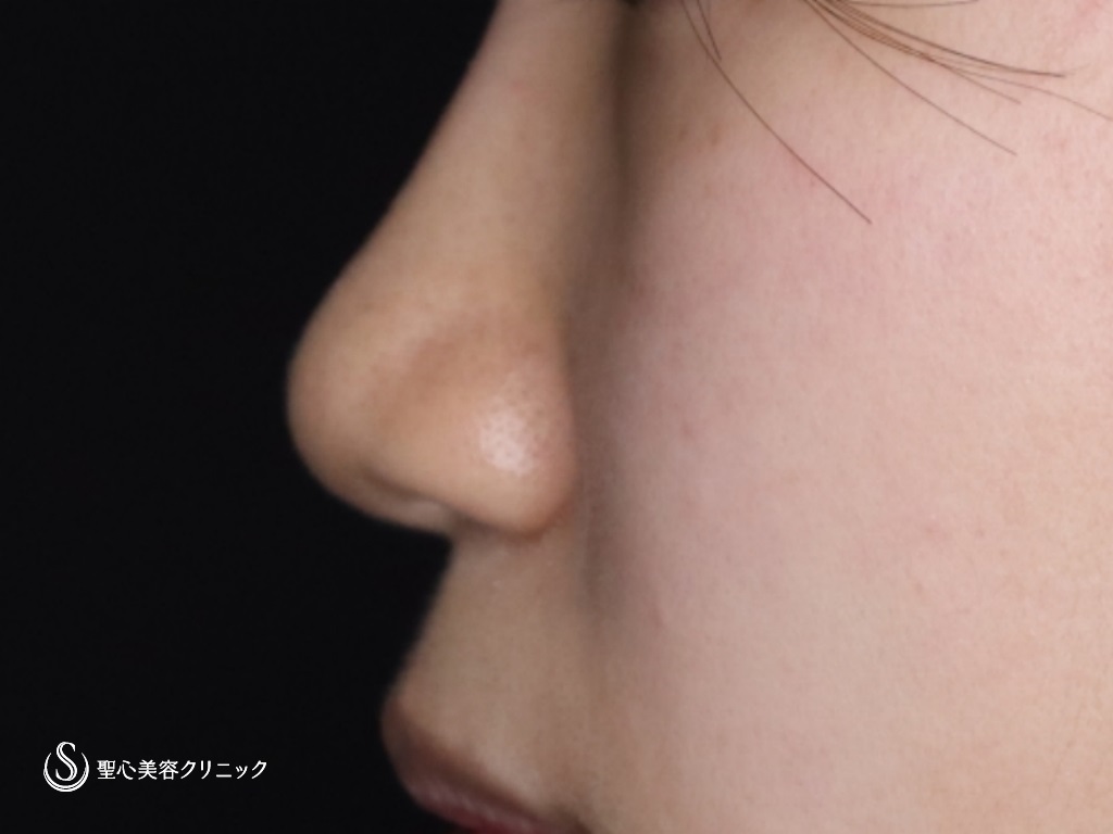 【10代女性・鼻先がスッキリ高く】鼻尖縮小+鼻尖形成（耳介軟骨移植）（3ヶ月後） Before 