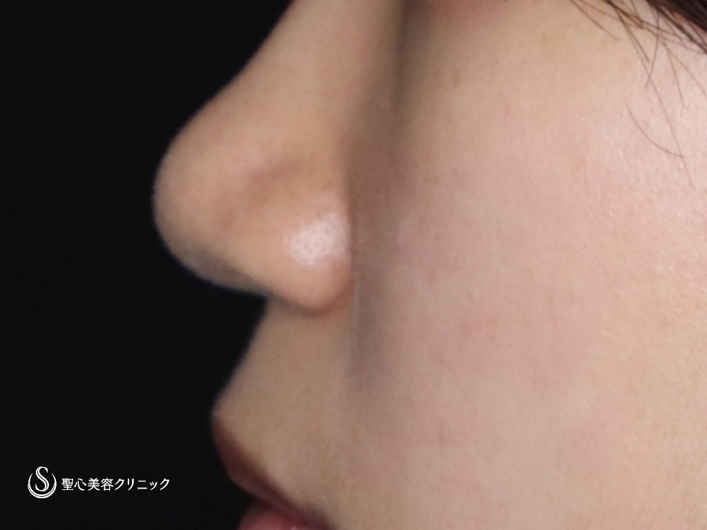 【10代女性・鼻先がスッキリ高く】鼻尖縮小+鼻尖形成（耳介軟骨移植）（3ヶ月後） After 