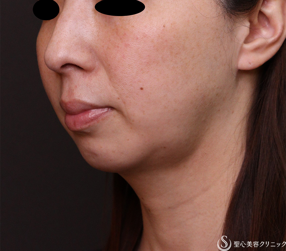 【30代女性・あご下の厚み】ウルトラセル[zíː]（リニア3回処置）（3か月後） Before 