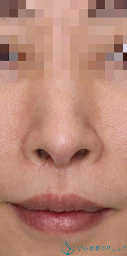 【30代女性・鼻の穴を目立ちにくくしたい！！】鼻孔縁下降術（術後3ヶ月） Before 