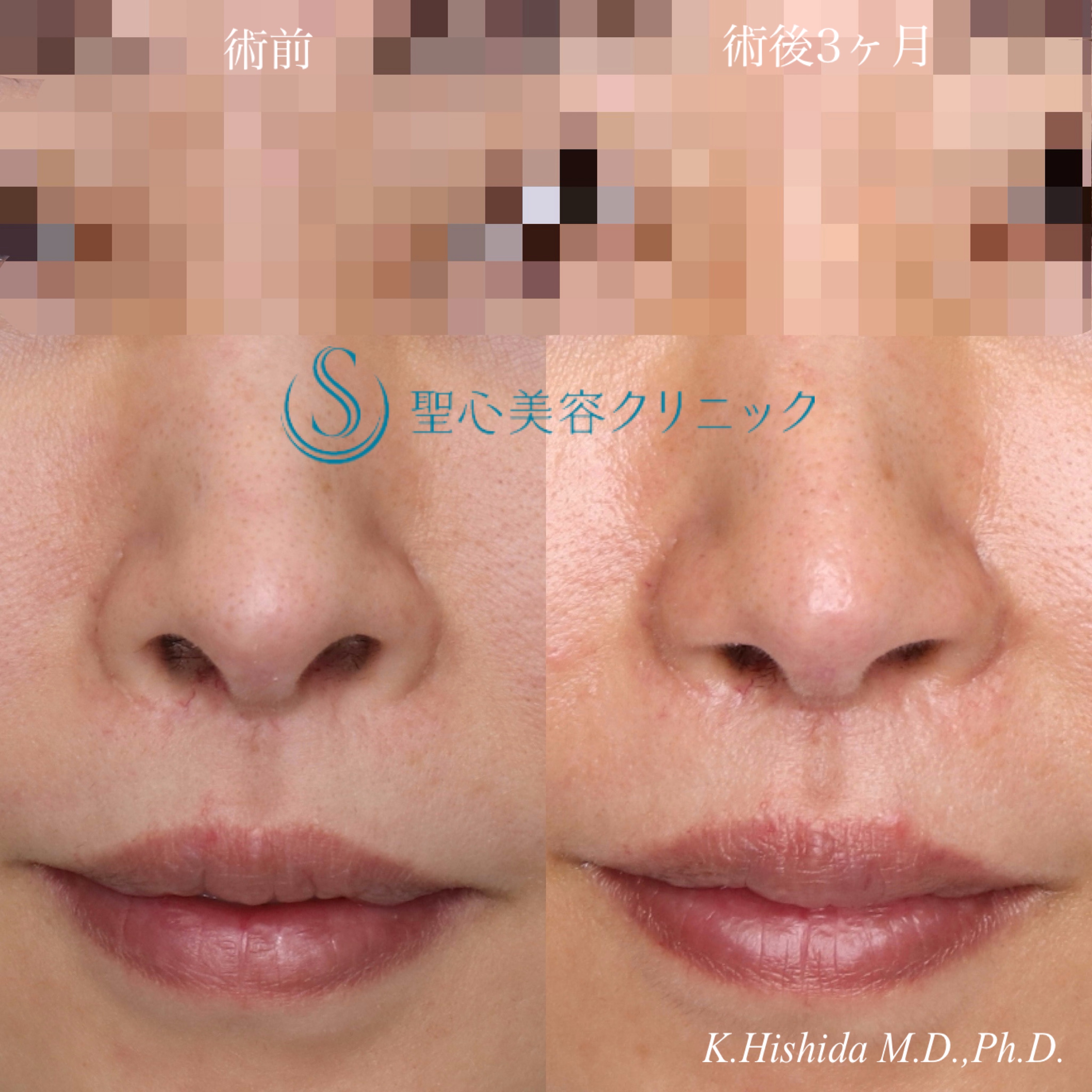 【30代女性・鼻の穴を目立ちにくくしたい！！】鼻孔縁下降術（術後3ヶ月） After 