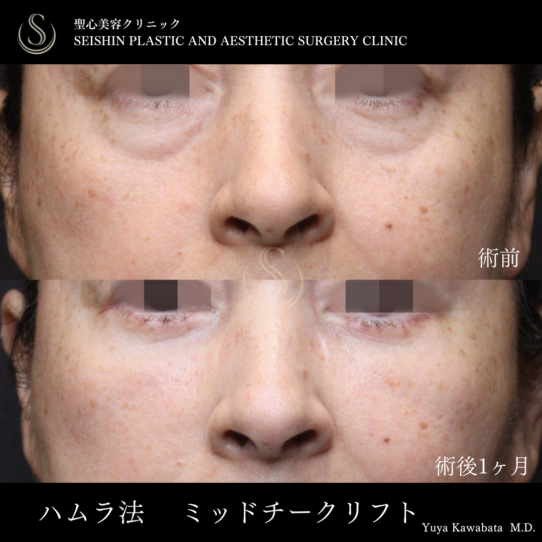 【50代女性・ハムラ法とミッドチークリフトでクマ取り&頬の挙上】下眼瞼切開術/下眼瞼除皺術/ハムラ法（術後1ヶ月） Before 
