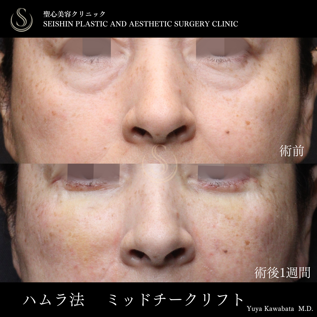 【50代女性・ハムラ法とミッドチークリフトでクマ取り&頬の挙上】下眼瞼切開術/下眼瞼除皺術/ハムラ法（術後1ヶ月） After 