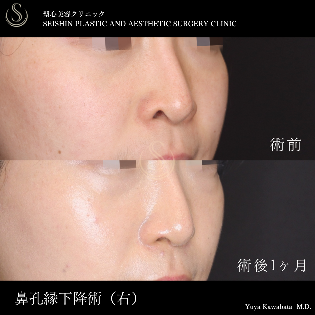 【20代女性・鼻の穴の尖りをととのえる】鼻孔縁下降術（術後1ヶ月） Before 