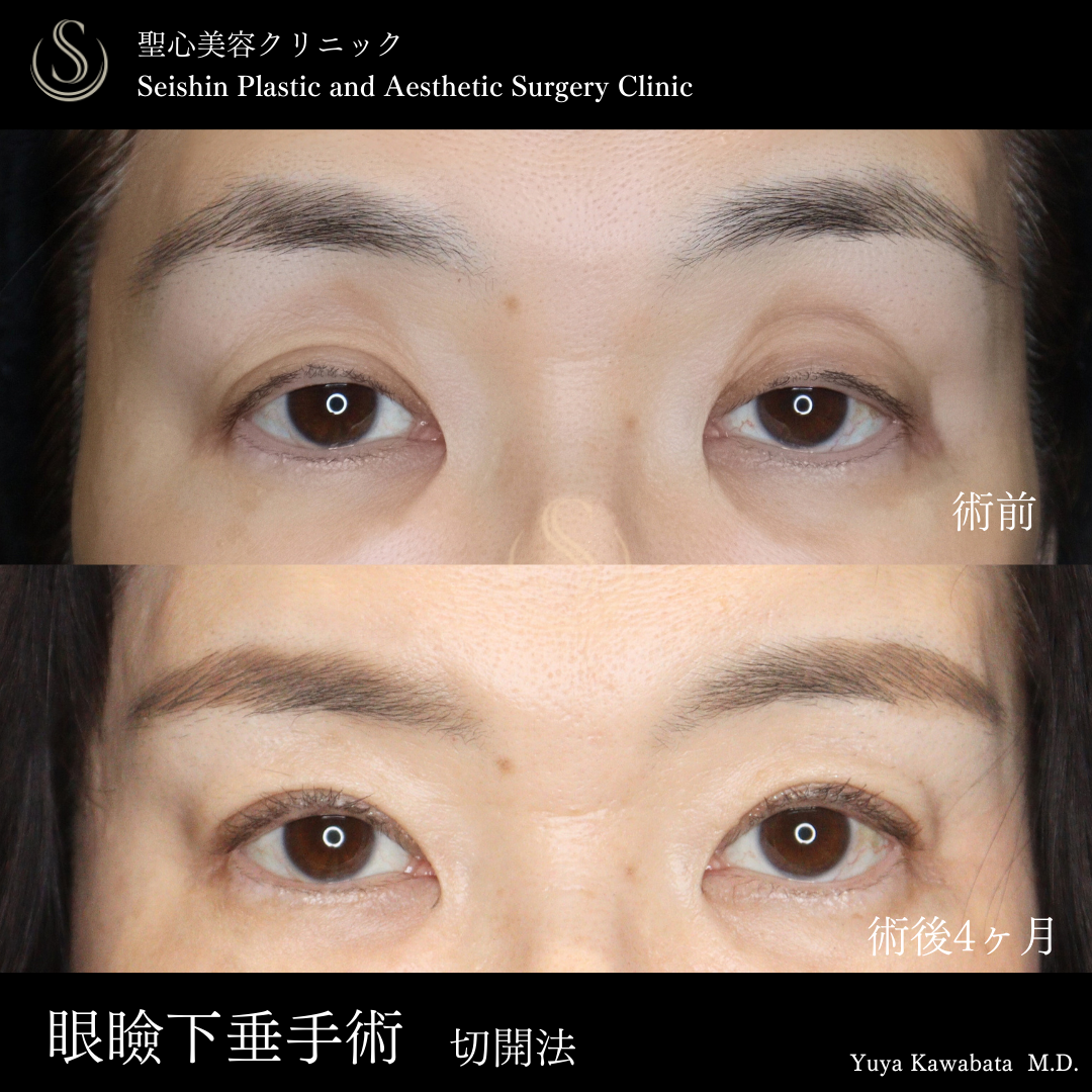 【50代女性・目の開きを改善】眼瞼下垂（腱膜縫縮法）（術後4ヶ月） Before 