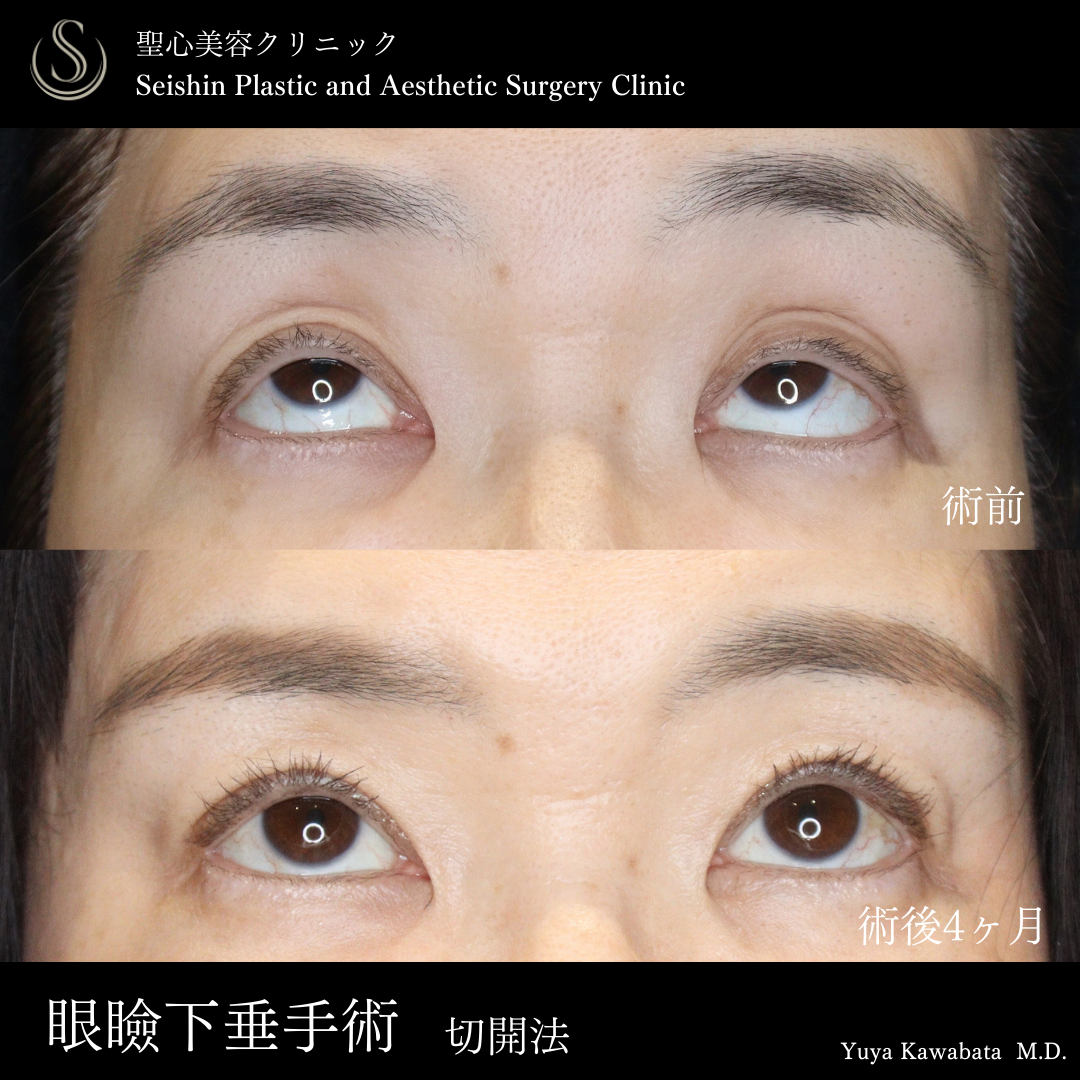 【50代女性・目の開きを改善】眼瞼下垂（腱膜縫縮法）（術後4ヶ月） After 