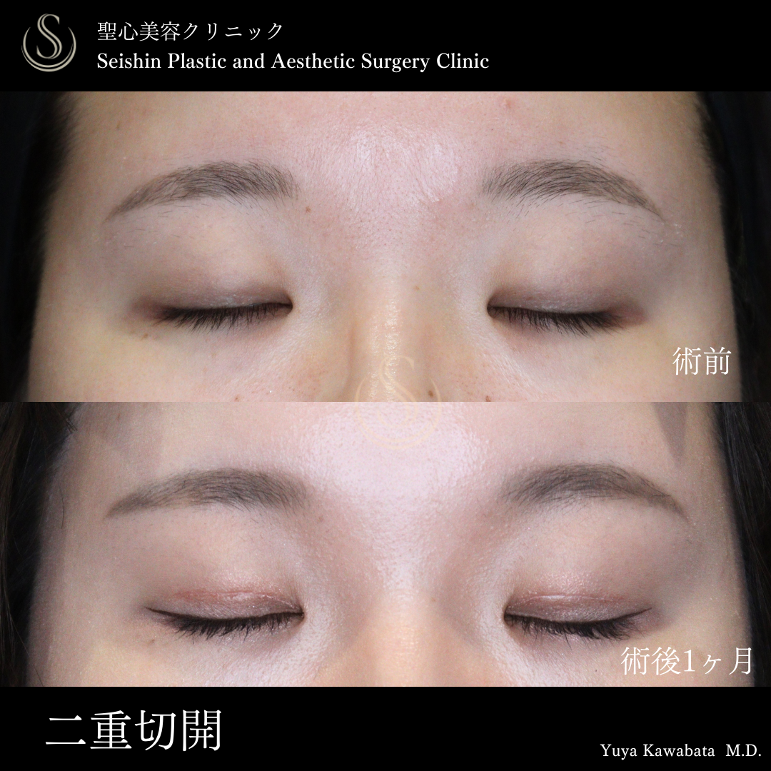 【20代女性・切開法で自然な二重に】二重術（切開法）（術後1ヶ月） After 
