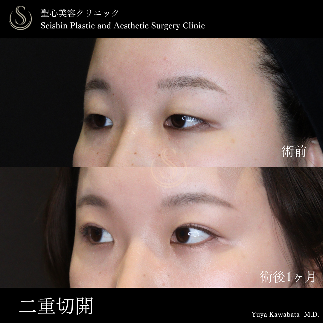 【20代女性・切開法で自然な二重に】二重術（切開法）（術後1ヶ月） After 