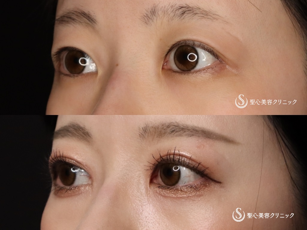 【20代女性・綺麗なミックス二重に】二重術（切開法）＋脱脂+目上切開（3か月後） After 