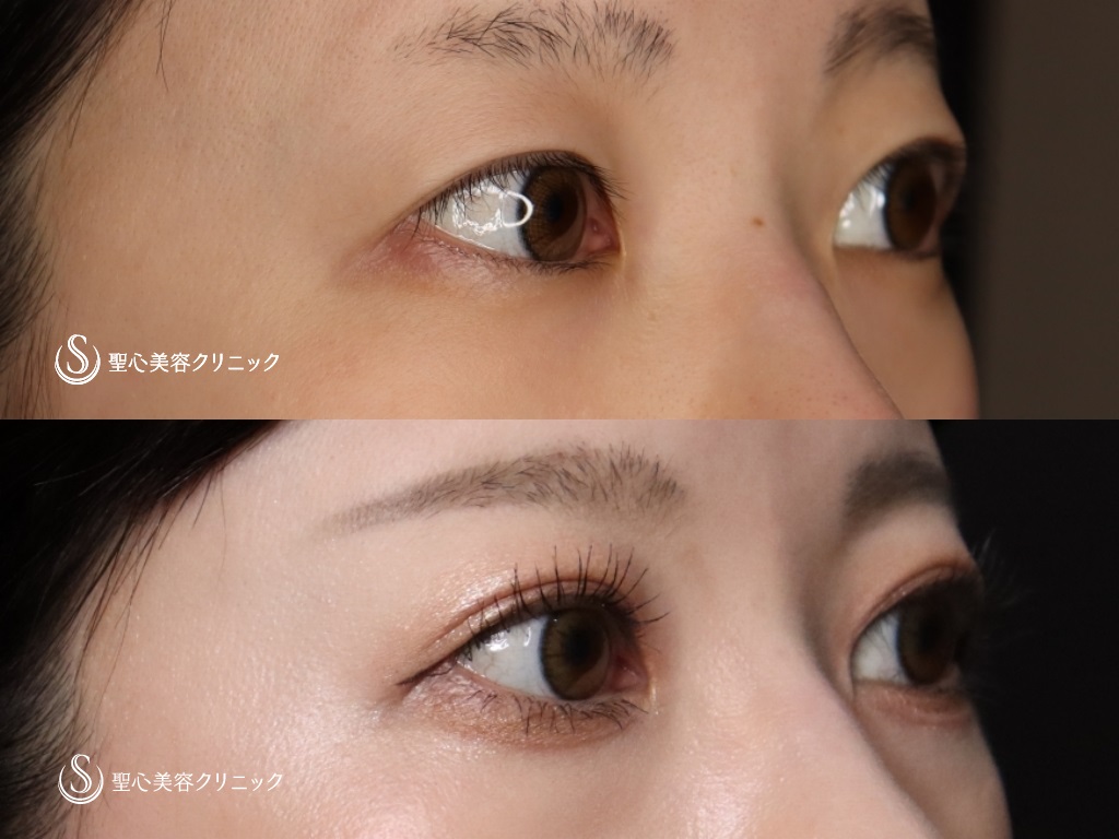 【20代女性・綺麗なミックス二重に】二重術（切開法）＋脱脂+目上切開（3か月後） After 
