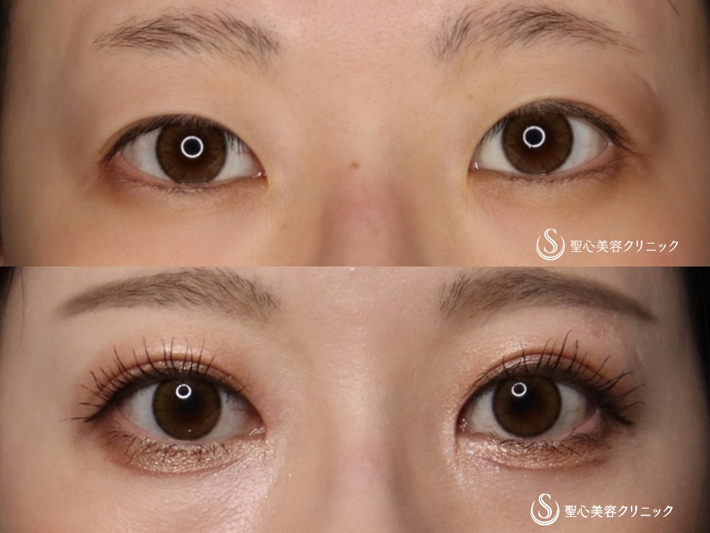 【20代女性・綺麗なミックス二重に】二重術（切開法）＋脱脂+目上切開（3か月後） After 