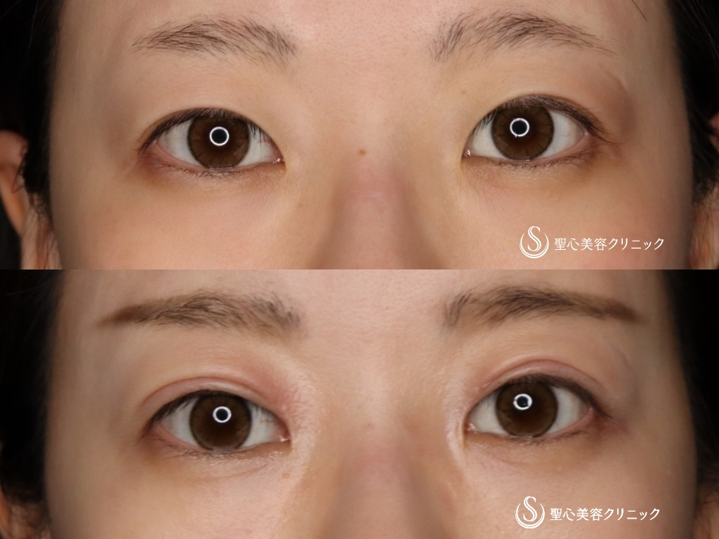 【20代女性・綺麗なミックス二重に】二重術（切開法）＋脱脂+目上切開（3か月後） After 