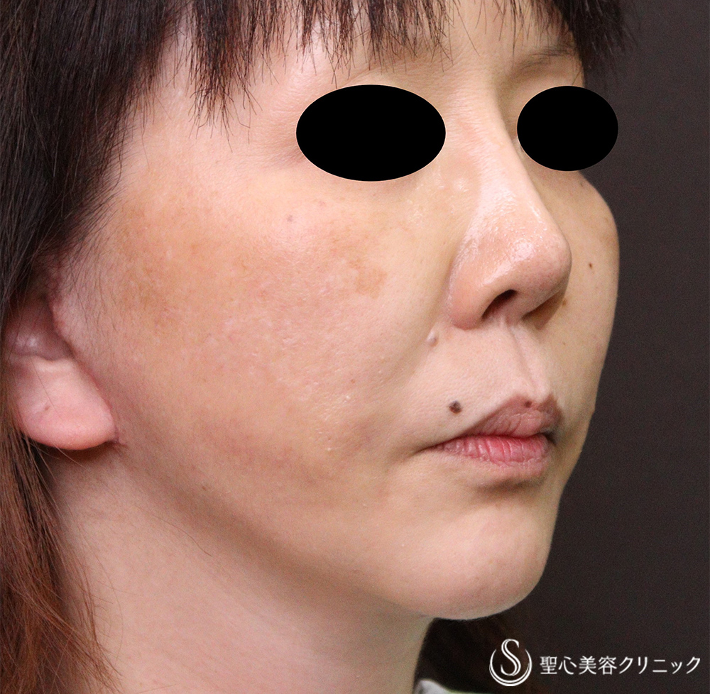 【50代女性・口元のたるみ】フェイスリフト+頬・あご下脂肪吸引（術後1か月） After 