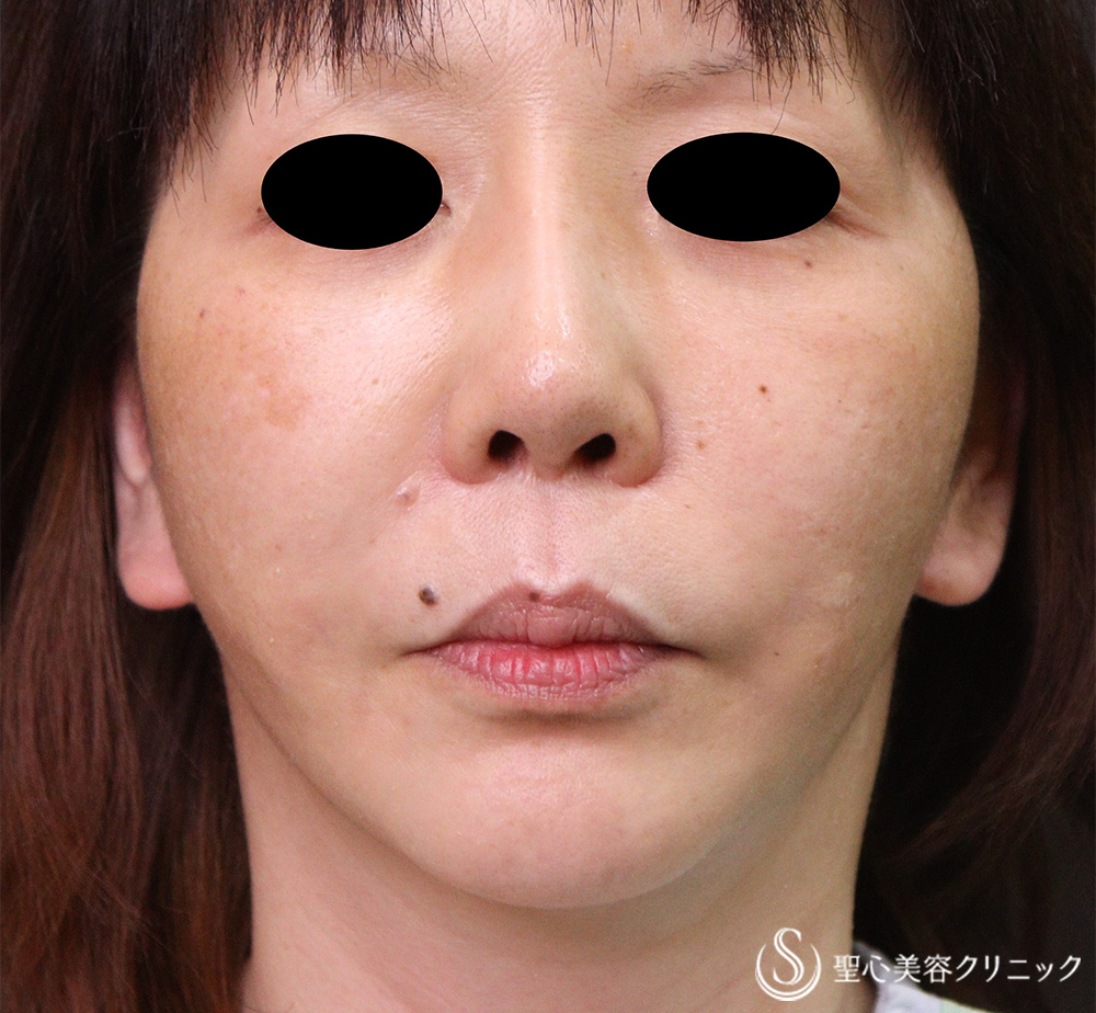 【50代女性・口元のたるみ】フェイスリフト+頬・あご下脂肪吸引（術後1か月） After 