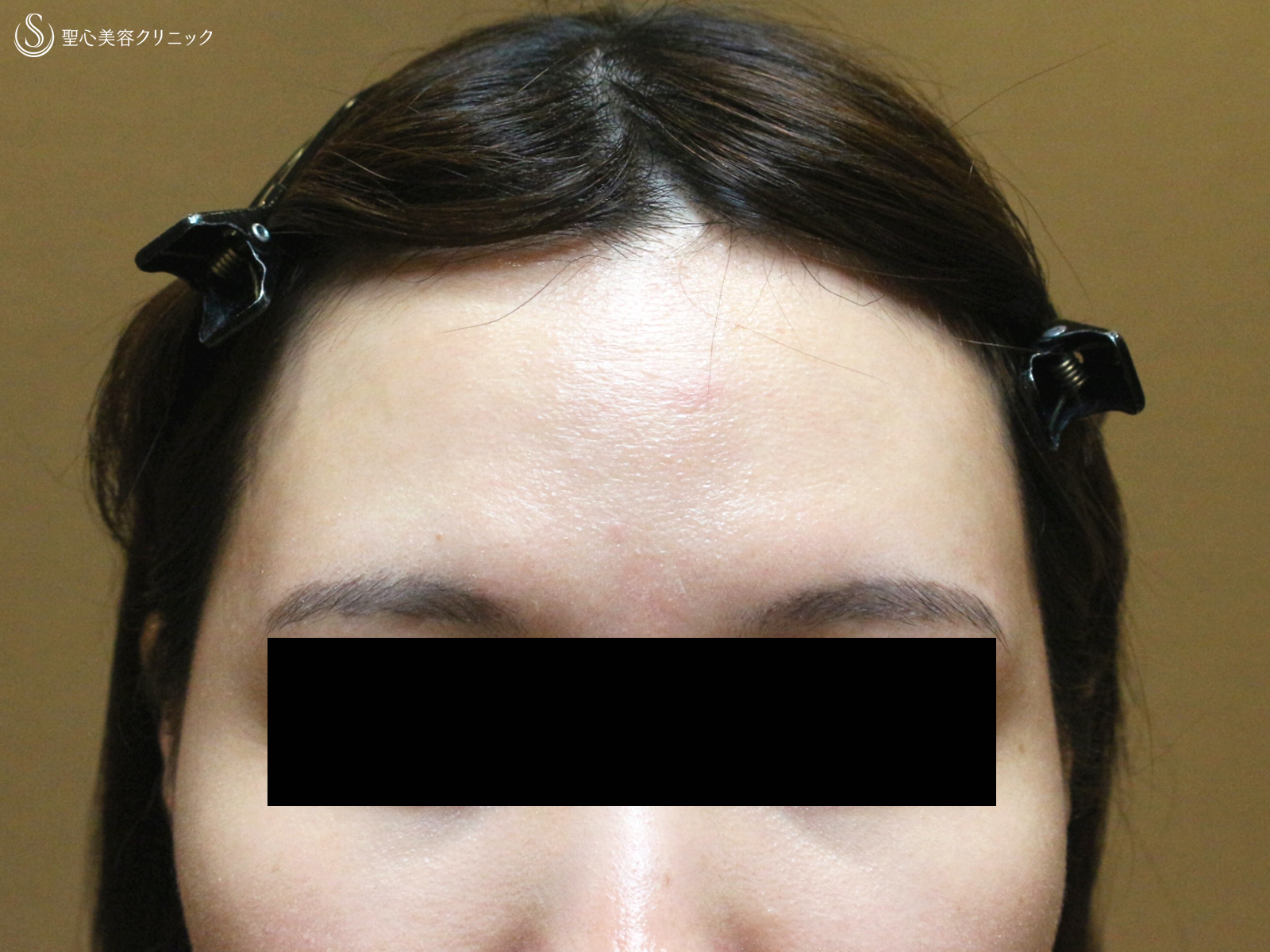 【30代女性・女性らしい丸いオデコをつくる】プレミアムPRP皮膚再生療法（直後〜6ヶ月後） Before 