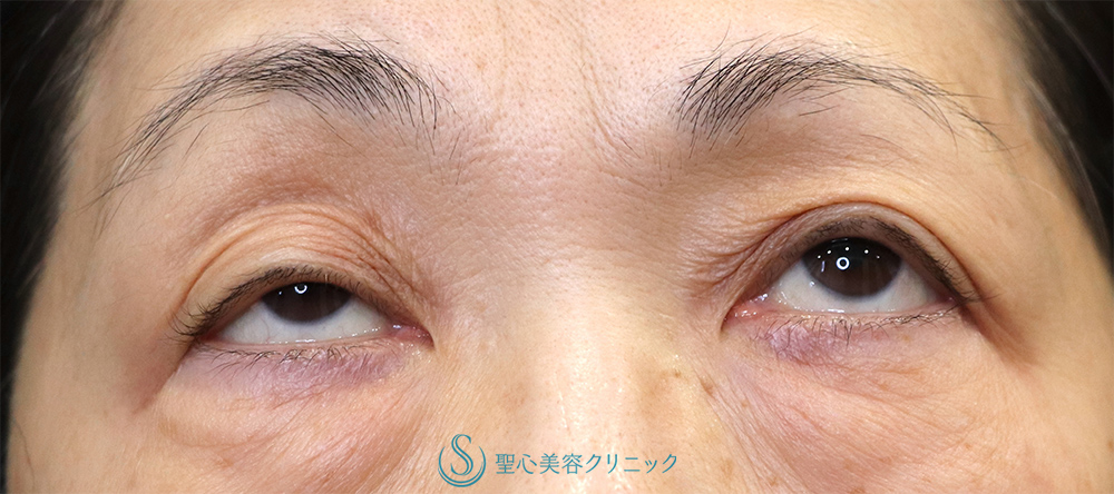 【60代女性・右目の下垂】眼瞼下垂（腱膜縫縮法）（1ヶ月後）　 Before 