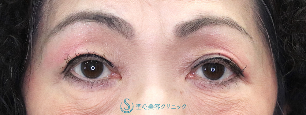 【60代女性・右目の下垂】眼瞼下垂（腱膜縫縮法）（1ヶ月後）　 After 
