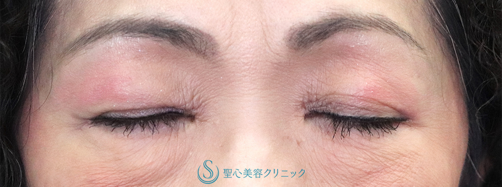 【60代女性・右目の下垂】眼瞼下垂（腱膜縫縮法）（1ヶ月後）　 After 