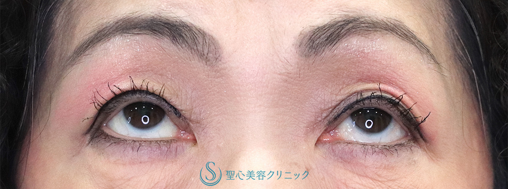 【60代女性・右目の下垂】眼瞼下垂（腱膜縫縮法）（1ヶ月後）　 After 